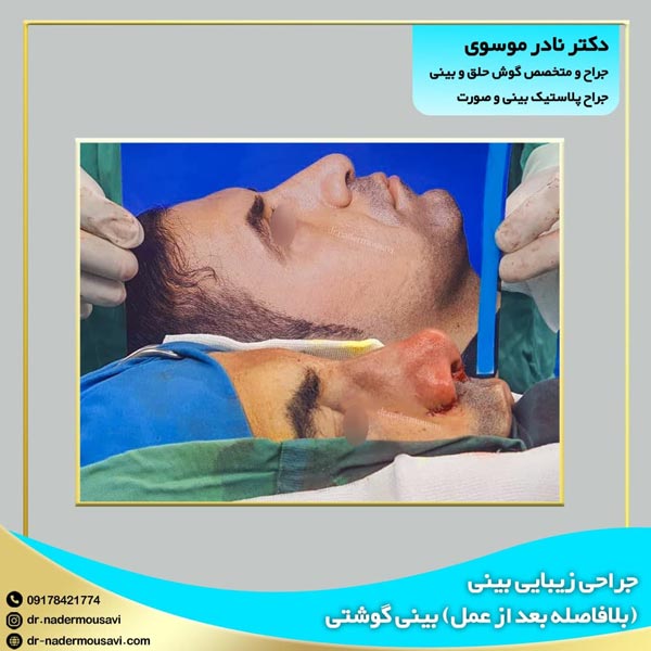 عکس قبل و بعد جراحی بینی گوشتی - دکتر نادر موسوی 