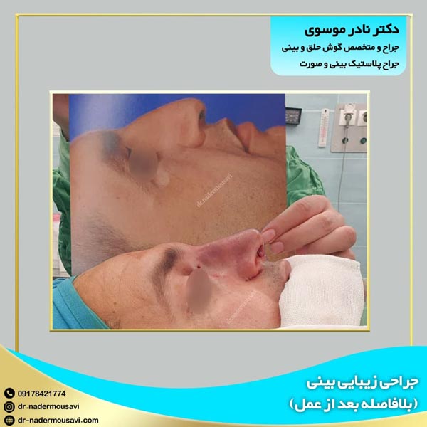 عکس قبل و بعد جراحی بینی - دکتر نادر موسوی