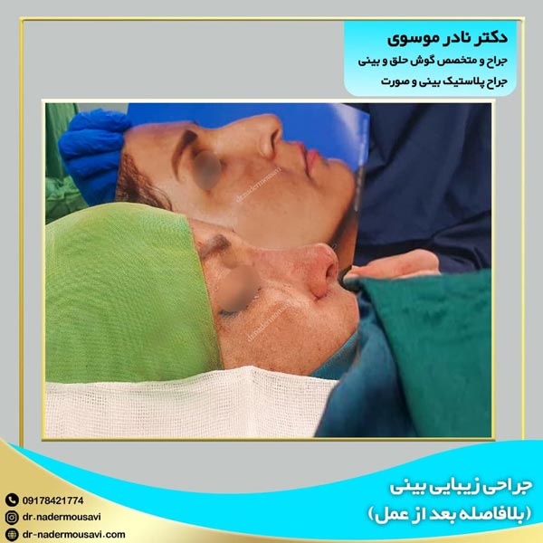 عکس قبل و بعد جراحی بینی - دکتر نادر موسوی
