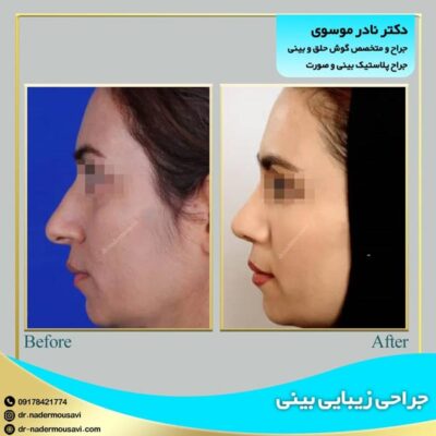 جراحی بینی