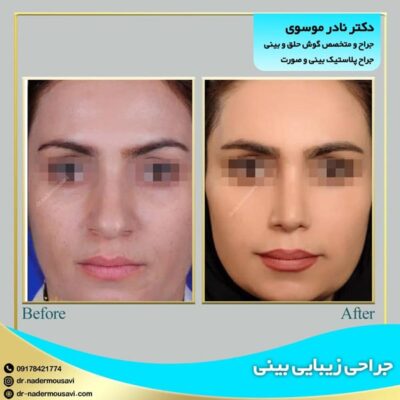 جراحی بینی - دکتر نادر موسوی