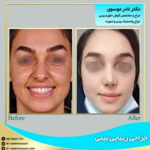 جراحی زیبایی بینی در شیراز