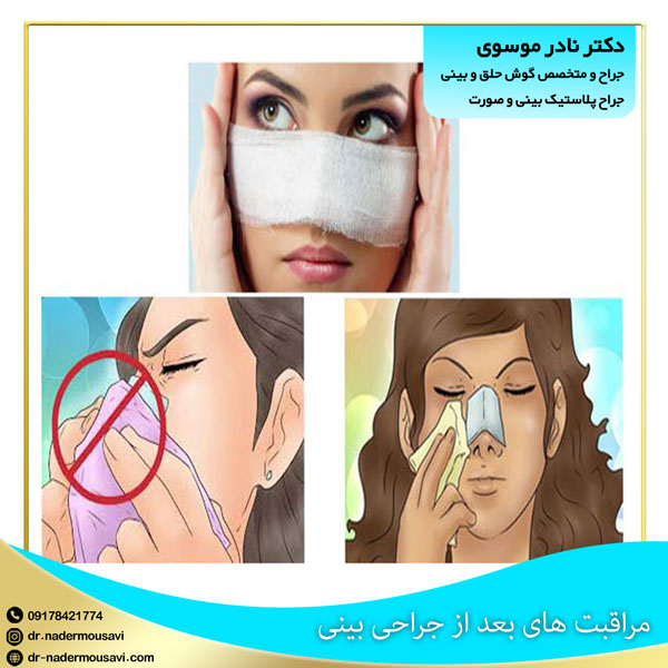 مراقبت های بعد از جراحی بینی - دکتر نادر موسوی
