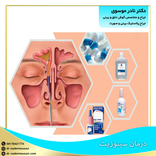 درمان سینوزیت - دکتر نادر موسوی