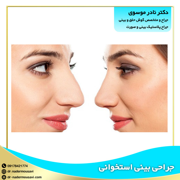 جراحی بینی استخوانی - دکتر نادر موسوی