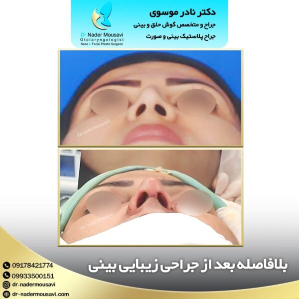 عکس قبل و بعد جراحی بینی استخوانی - دکتر نادر موسوی