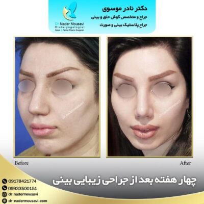 جراحی بینی گوشتی