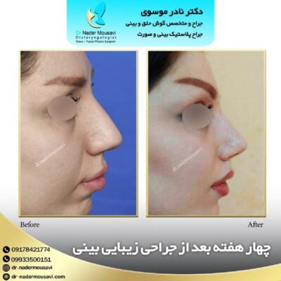 جراحی بینی گوشتی