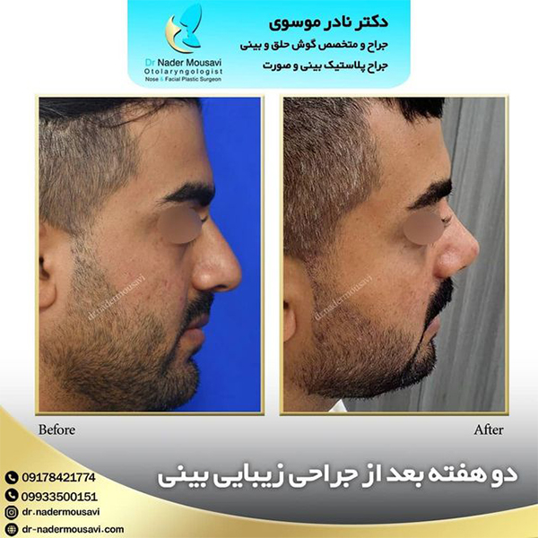 عکس قبل و بعد جراحی بینی استخوانی - دکتر نادر موسوی