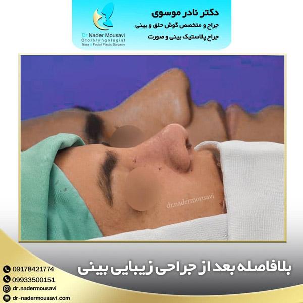 عکس قبل و بعد جراحی بینی - دکتر نادر موسوی