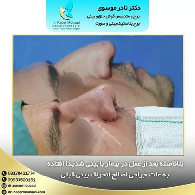 جراحی بینی