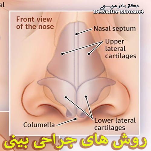 روش های جراحی بینی - دکتر نادر موسوی