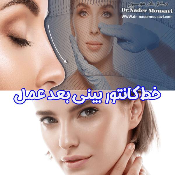 خط کانتور بینی بعد عمل - دکتر نادر موسوی
