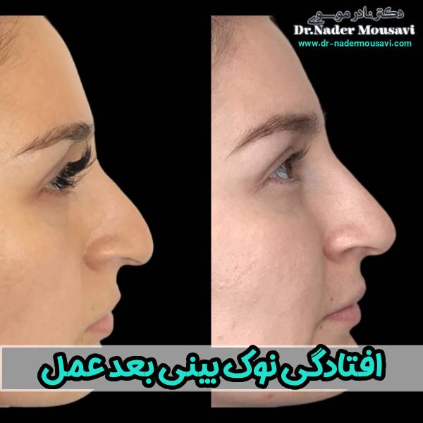 افتادگی نوک بینی بعد عمل - دکتر نادر موسوی
