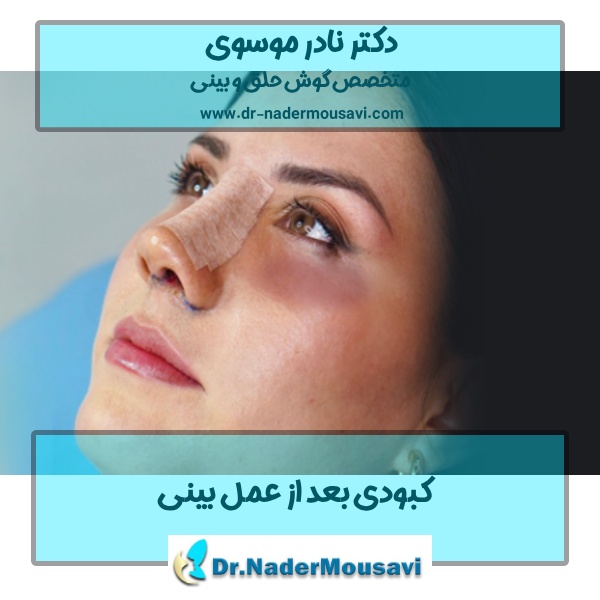 کبودی بعد از عمل بینی