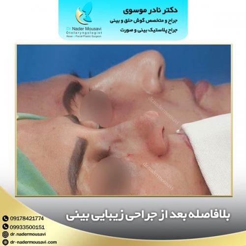 جراحی-زیبایی-بینی-126