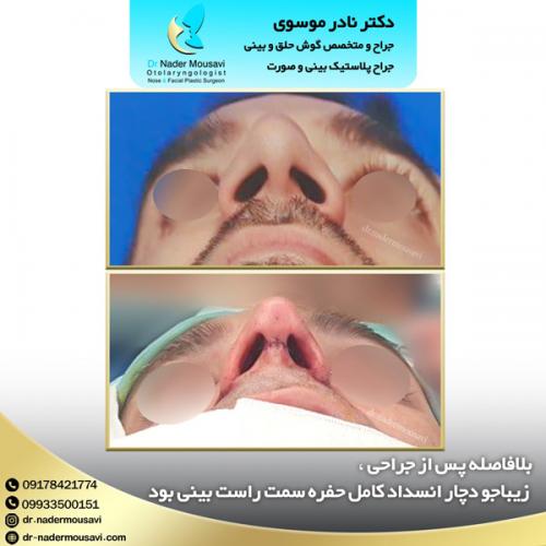 جراحی-زیبایی-بینی-127