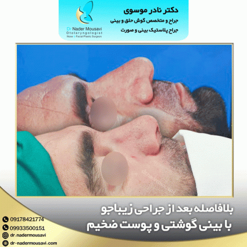 جراحی-زیبایی-بینی-130