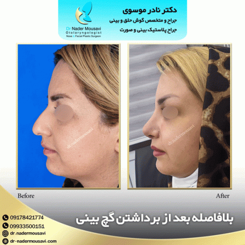 جراحی-زیبایی-بینی-131