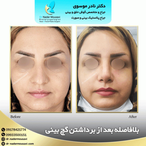 جراحی-زیبایی-بینی-132