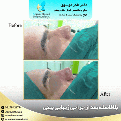 جراحی-زیبایی-بینی-134