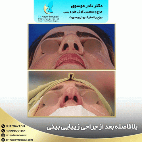 جراحی-زیبایی-بینی-135