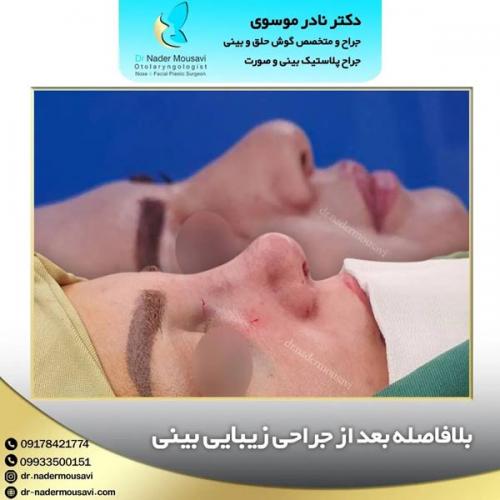 جراحی-زیبایی-بینی-136