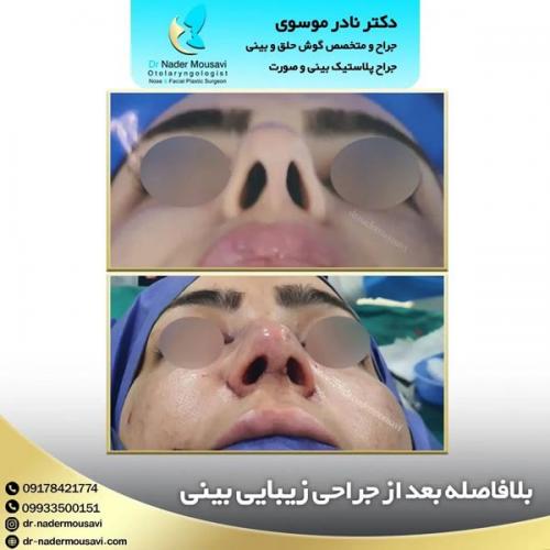 جراحی-زیبایی-بینی-137