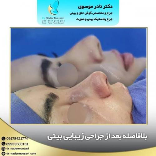 جراحی-زیبایی-بینی-138