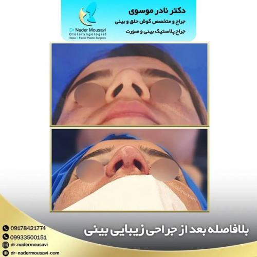 جراحی-زیبایی-بینی-139