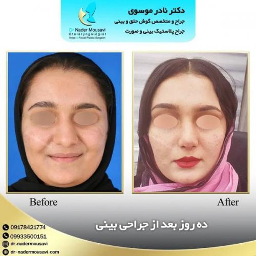 جراحی-زیبایی-بینی-141