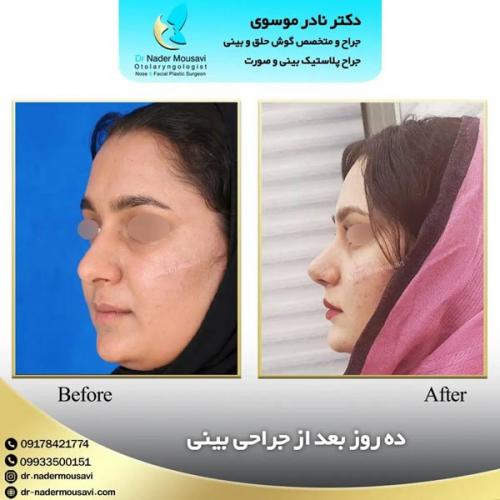 جراحی-زیبایی-بینی-142