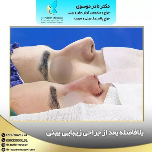 جراحی-زیبایی-بینی-143