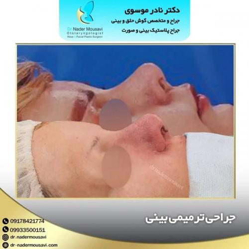 جراحی-زیبایی-بینی-145