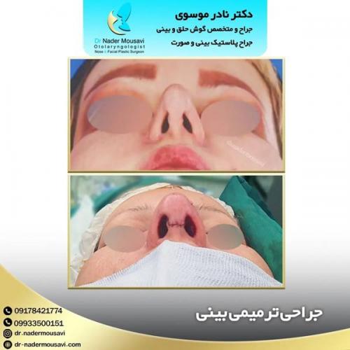 جراحی-زیبایی-بینی-146