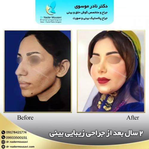 جراحی-زیبایی-بینی-147