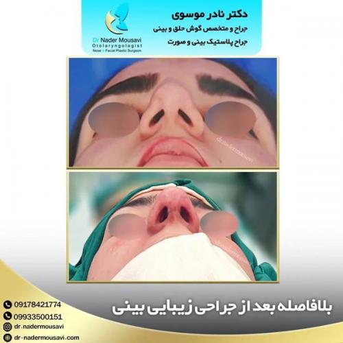جراحی-زیبایی-بینی-148