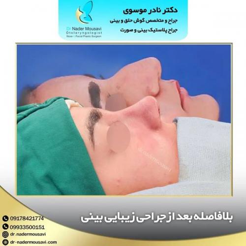 جراحی-زیبایی-بینی-149