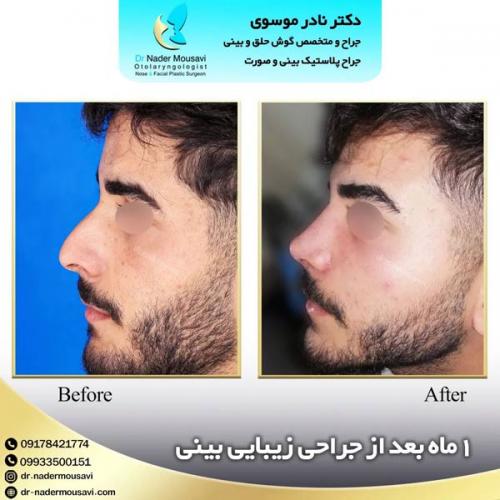 جراحی-زیبایی-بینی-152