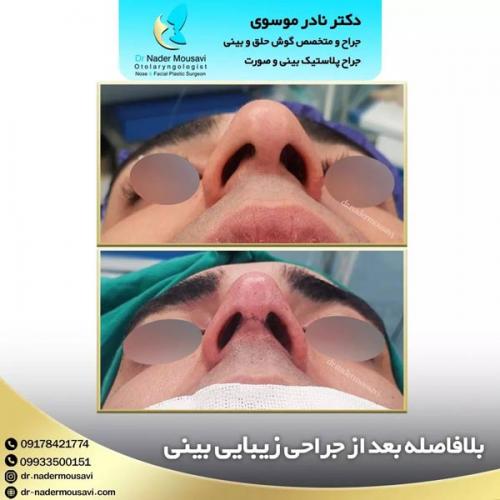 جراحی-زیبایی-بینی-154