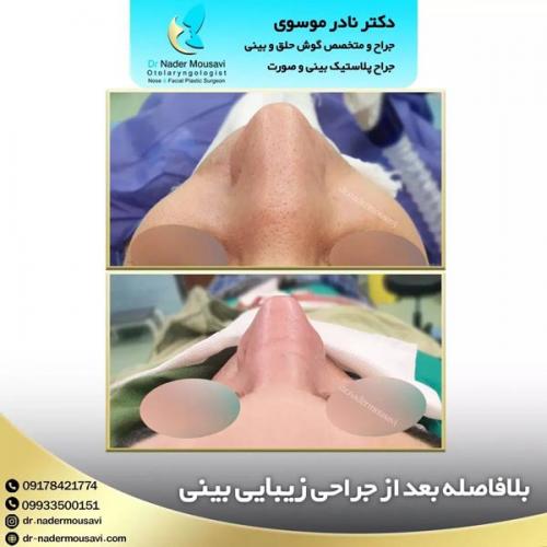 جراحی-زیبایی-بینی-155