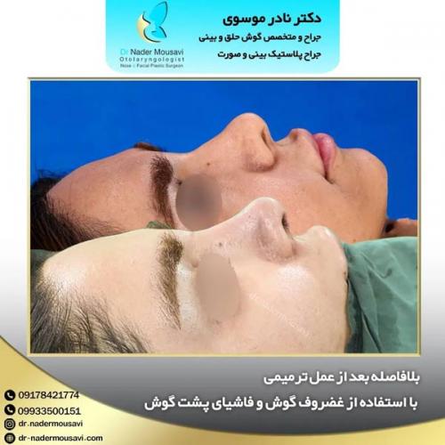 جراحی-زیبایی-بینی-156