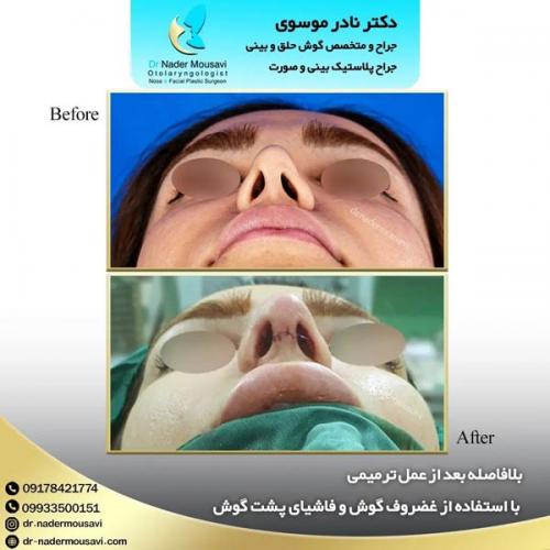 جراحی-زیبایی-بینی-157