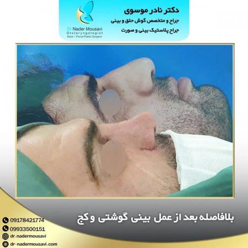 جراحی-زیبایی-بینی-158