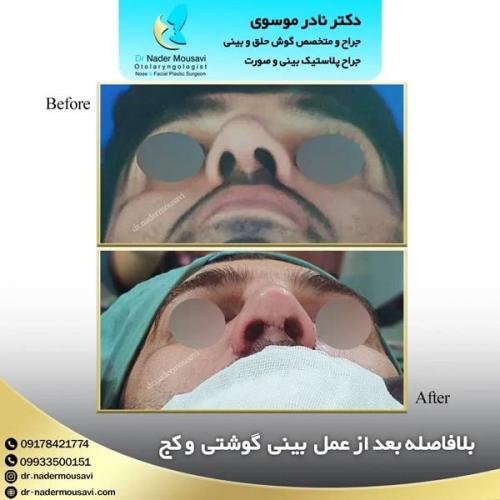 جراحی-زیبایی-بینی-159