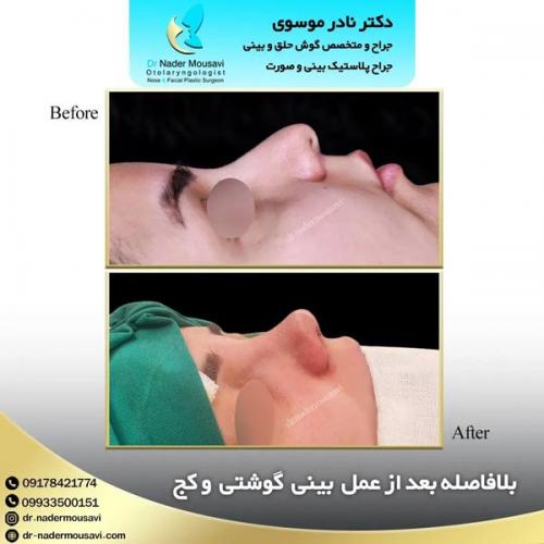 جراحی-زیبایی-بینی-160