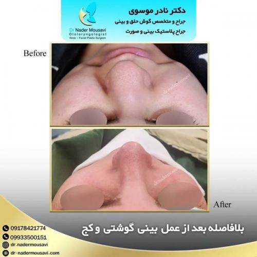 جراحی-زیبایی-بینی-161