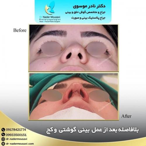 جراحی-زیبایی-بینی-162