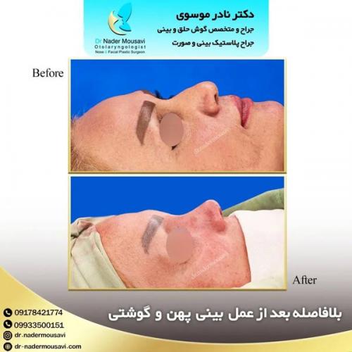 جراحی-زیبایی-بینی-163