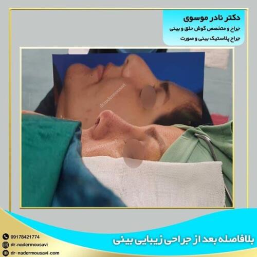 جراحی-زیبایی-بینی-25